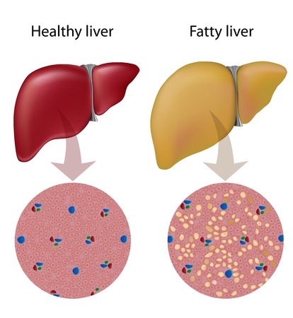 treatment natural for fatty liver